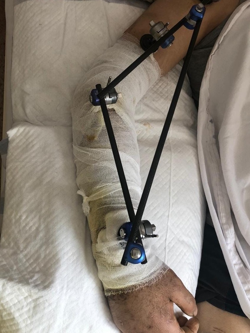 Шымкенттік дәрігерлер қол сүйегі сынған жігітке күрделі ота жасады