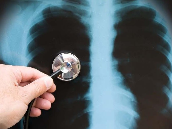 Атырау: 22 науқастың екеуінде пневмония бар