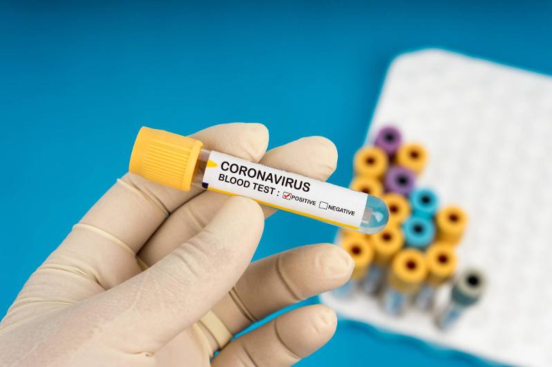Коронавирус инфекциясын жұқтырған тағы 22 адам тіркелді