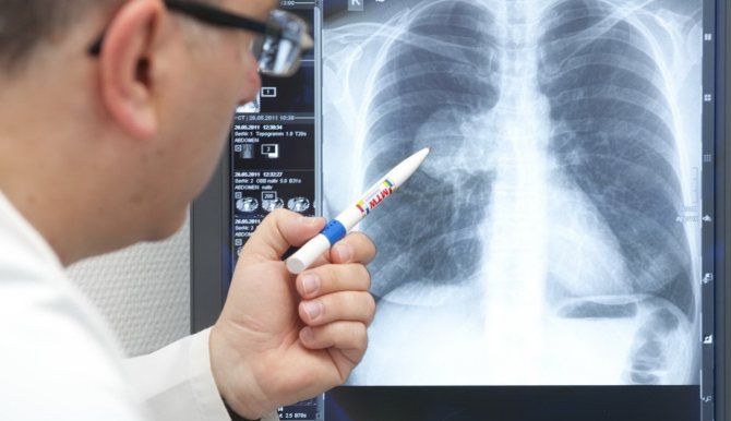 Шымкентте пневмониямен ауырған науқастардың 80 пайызы жазылып шықты