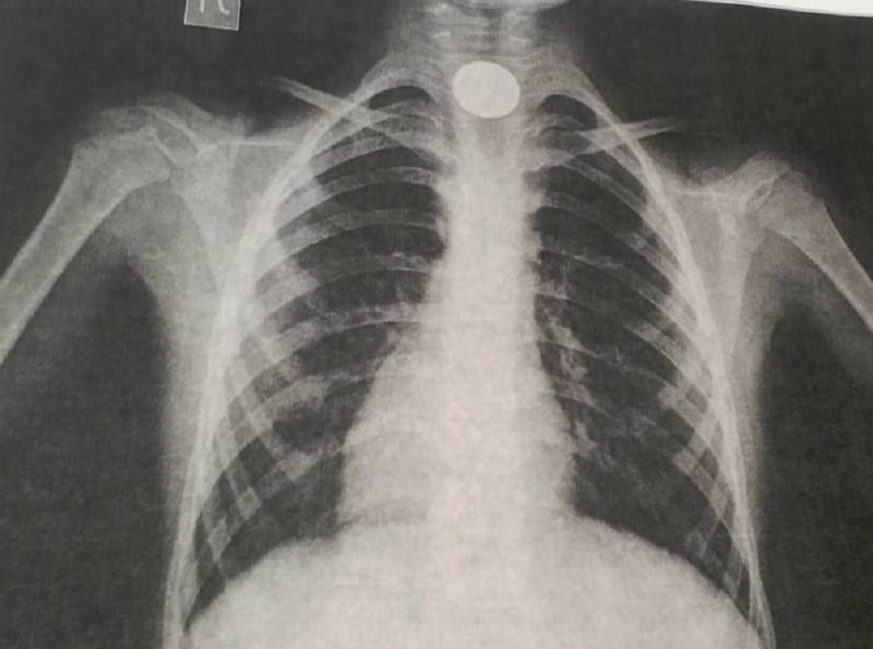 Тараздық дәрігерлер өңешінде тиын тұрып қалған баланы аман алып қалды