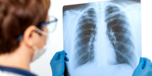 Өкпесі 90 пайыз зақымданған жүкті әйел емделіп шықты